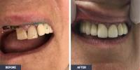 Implant Dentures image 4